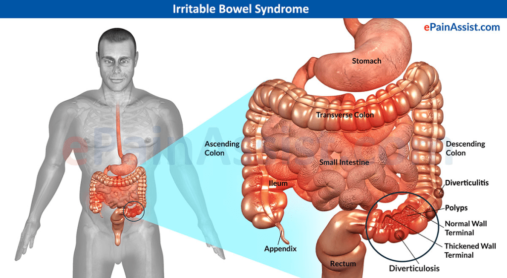 “Medical infographic showing IBS with diagrams of intestines”